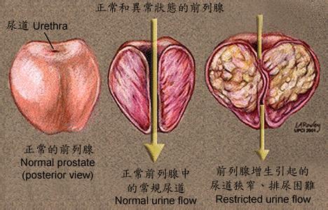 香河男科帮帮我前列腺炎_细菌性前列腺炎