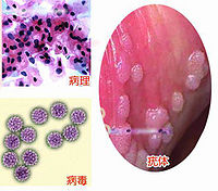 尖锐湿疣潜伏期