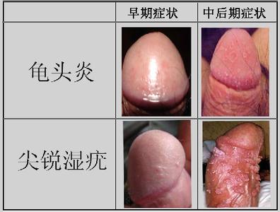  常见于龟头和冠状沟