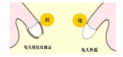 在宜春做包皮手术有哪些好处
