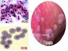 什么是尖锐湿疣呢