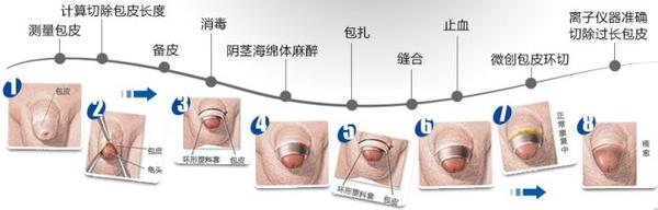 包茎的危害到底有哪些?