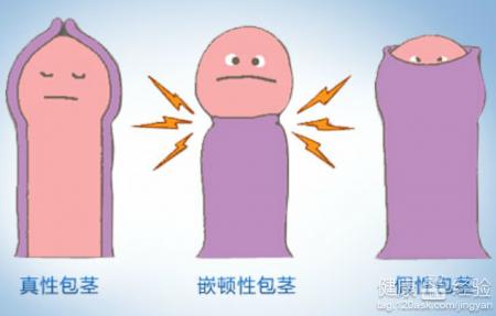 患了包茎有哪些危害?