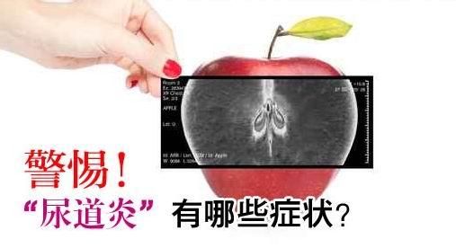 宜春男人尿道炎有什么症状呢