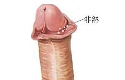 怎么判断是否有非淋感染呢?