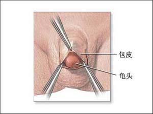 龟头炎的发生常常有什么危害?