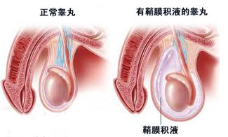 宜春鞘膜积液的分类