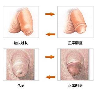 阿拉尔早泄到哪里治?