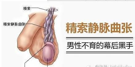 男人患精索静脉曲张有什么原因?