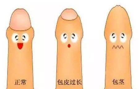 真人自述丨割包皮的真实流程!快进来看看吧!