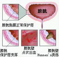 从哪些方面判断膀胱炎?长期尿频!