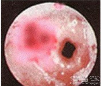 非淋的早期症状表现有哪些呢?