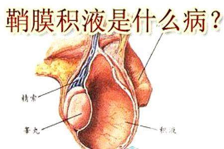 鞘膜积液热敷行吗？隐患与治疗