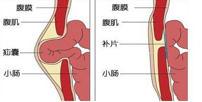 宜春治疗鞘膜积液选什么样的医院好?