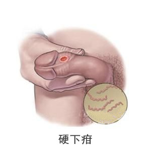 性病的早期信号有哪些?你都了解吗-梅毒