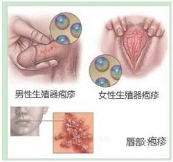 性病的早期信号有哪些?你都了解吗-生殖器疱疹