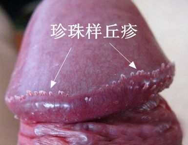 怎么判断真假尖锐湿疣-尖锐湿疣由人乳头瘤病毒引起