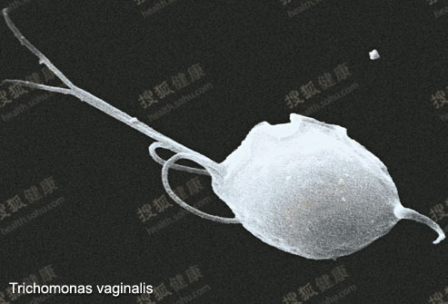 看清性病背后的“元凶”-滴虫病