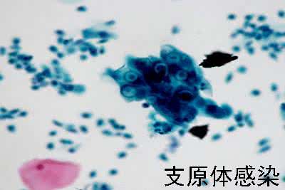 了解支原体感染会得不孕不育吗