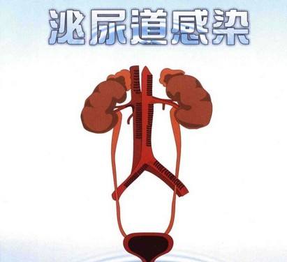 泌尿感染