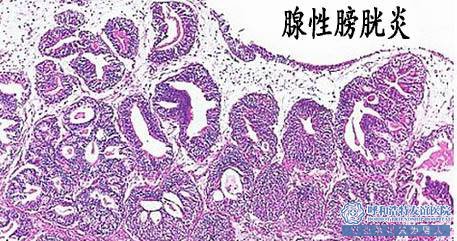 宜春宜春医院-腺性膀胱炎