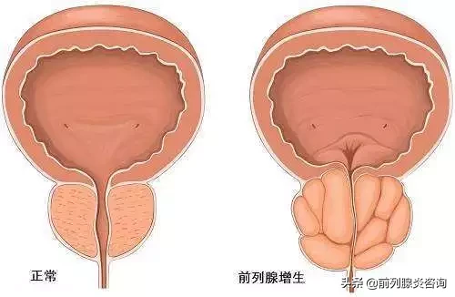 前列腺大就是前列腺增生吗？7个常见误区一次澄清